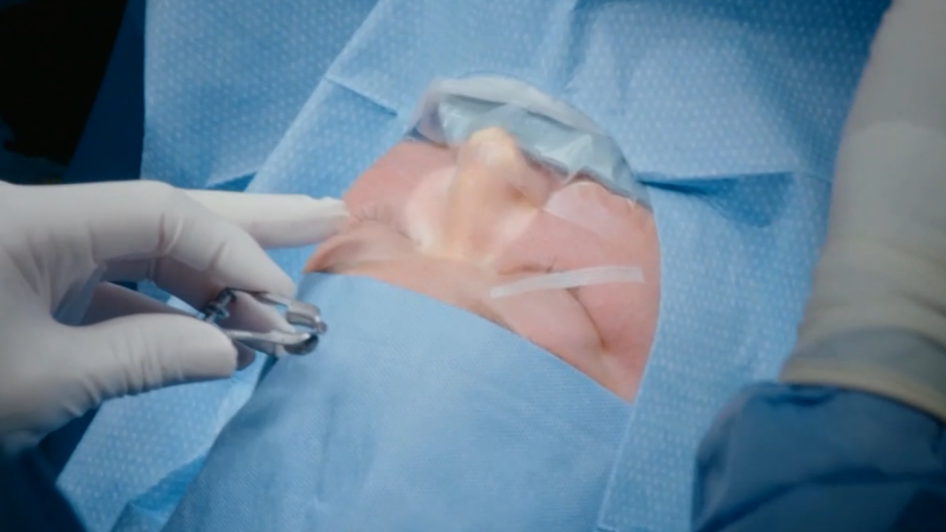 Amy Slaton undergoes eye surgery.