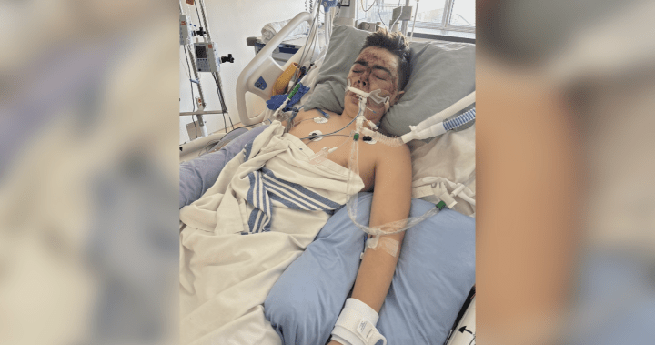 Okanagan Falls teen seriously injured in skiing accident at Apex Mountain Resort